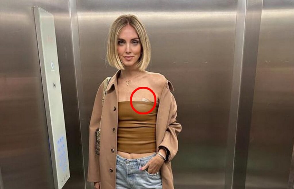 Chiara Ferragni mostra il cerotto e parla dell'esame istologico del presunto melanoma